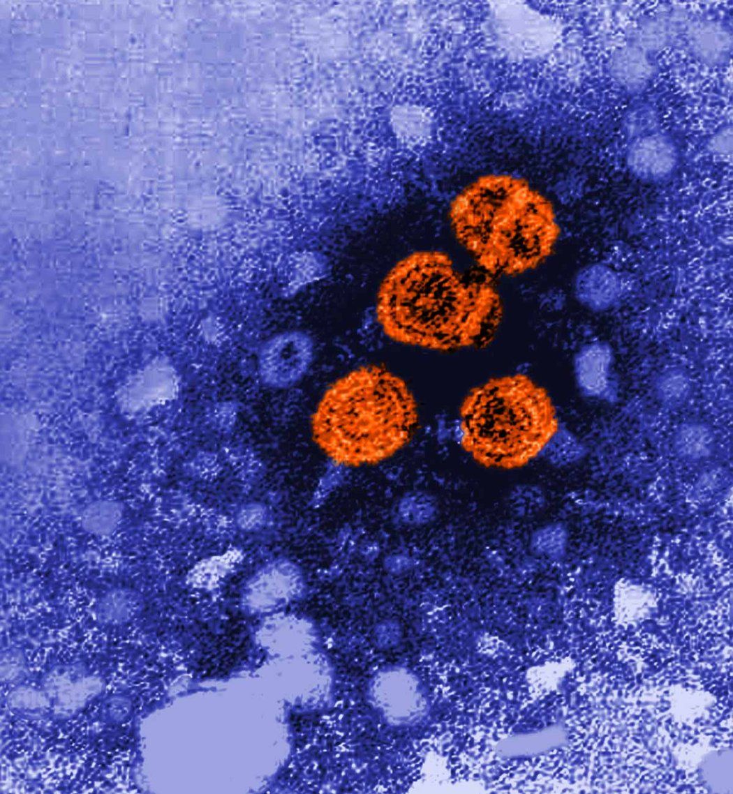 Electron microscopic image showing hepatitis B virus particles, which are round orange viroids.