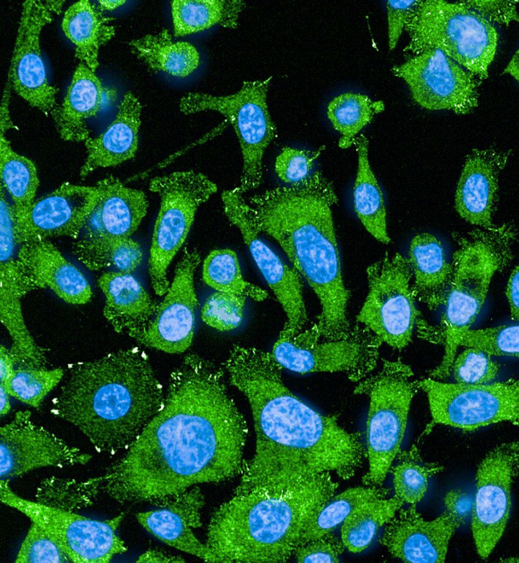 Fluorescence microscope image showing a dense field of lung cancer cells covering most of the image. The cells are green with blue nuclei and are closely packed together before treatment.