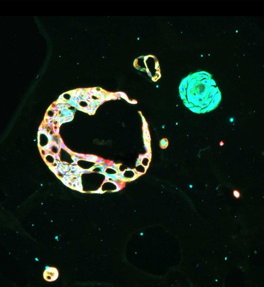 A microscopic image showing breast cancer organoids, which are round and crescent shaped shapes on a dark background.