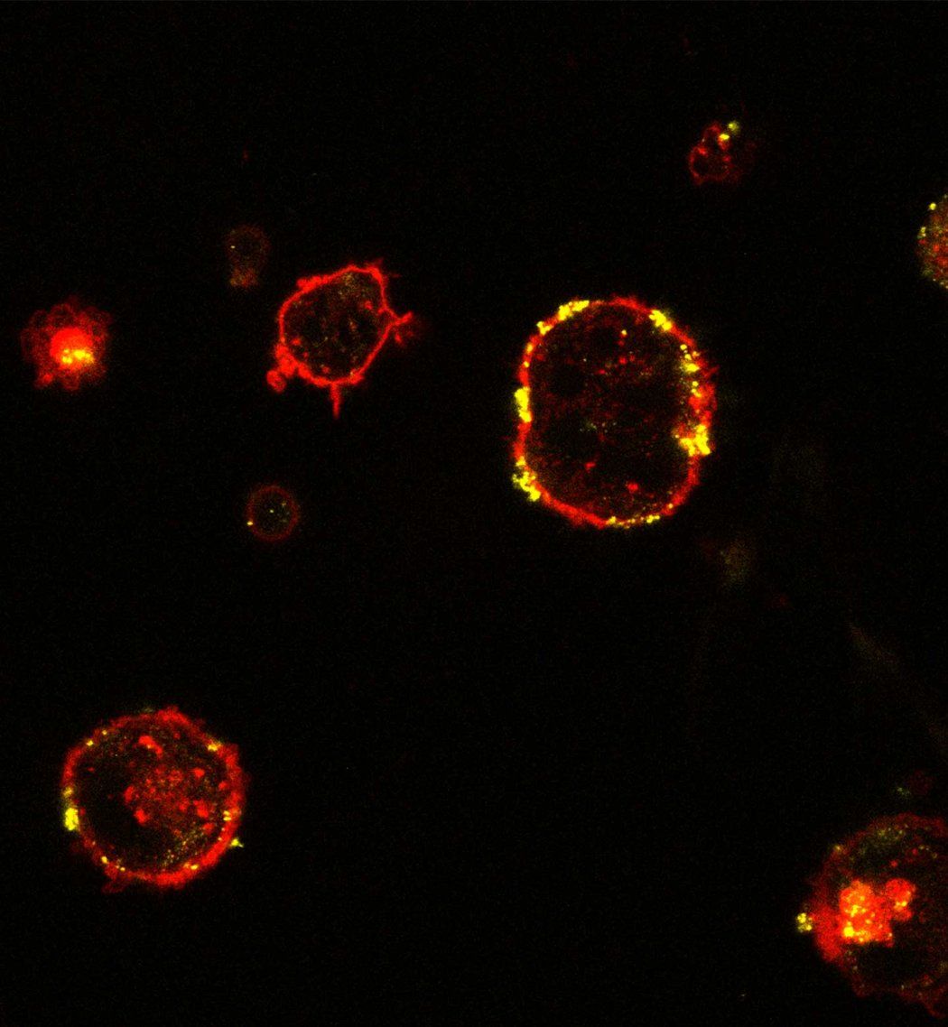 Microscopy image of lab-grown dendritic cells in red with absorbed tumor cell fragments highlighted in yellow.