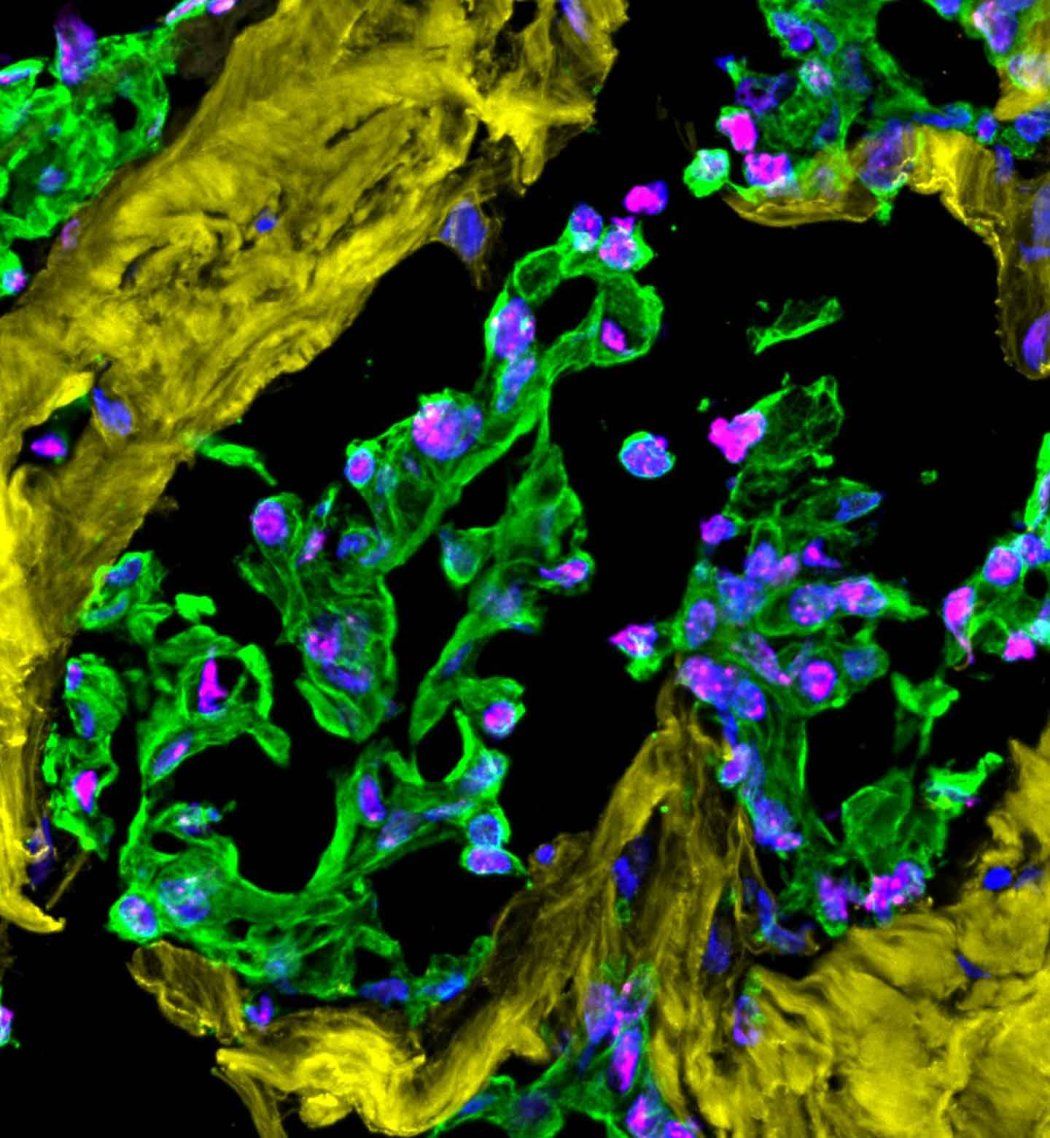 Fluorescent microscopy image of a fibrotic breast tumor, with DNA damage highlighted in pink.