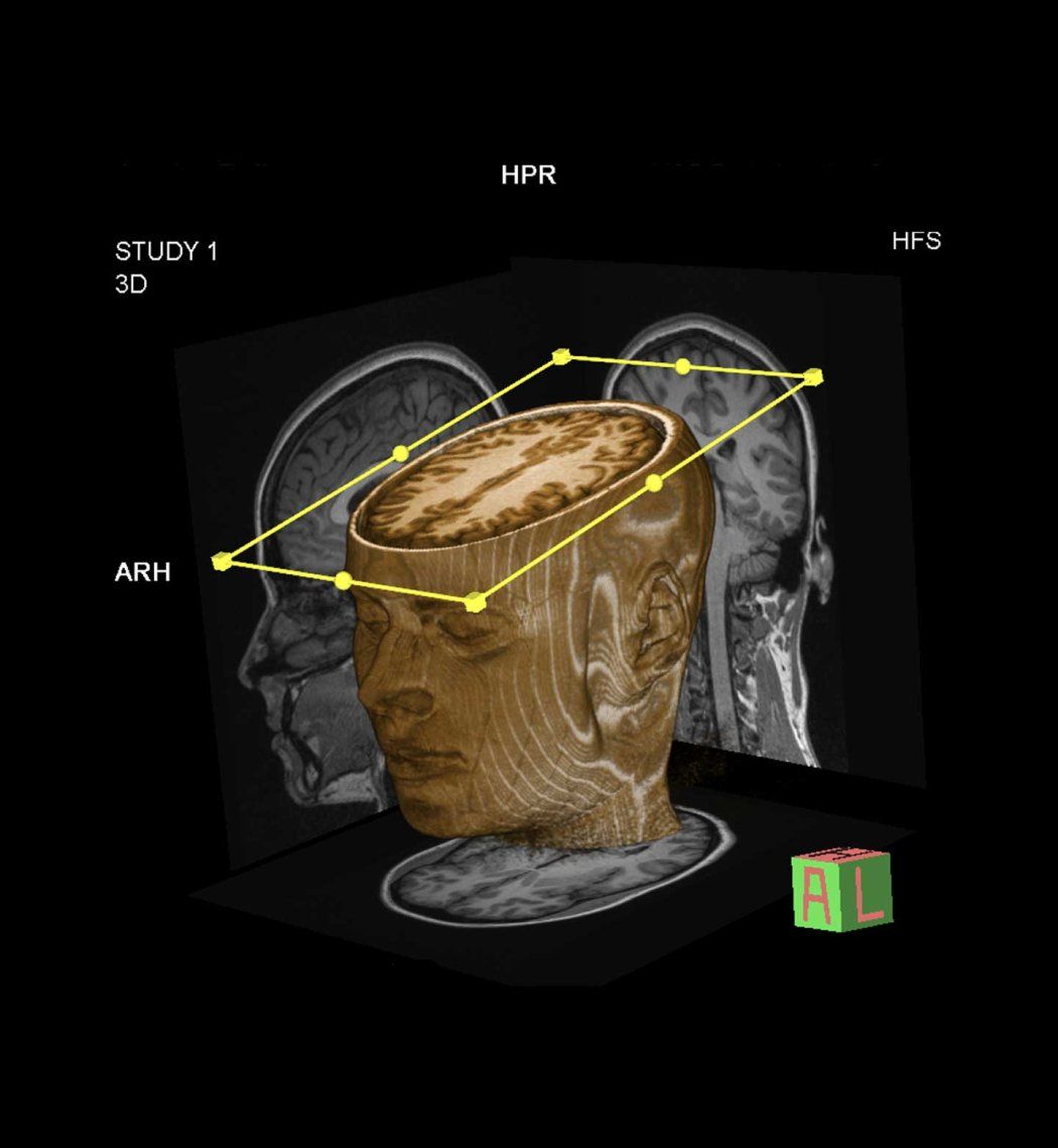 A 3D rendering of a face and brain.