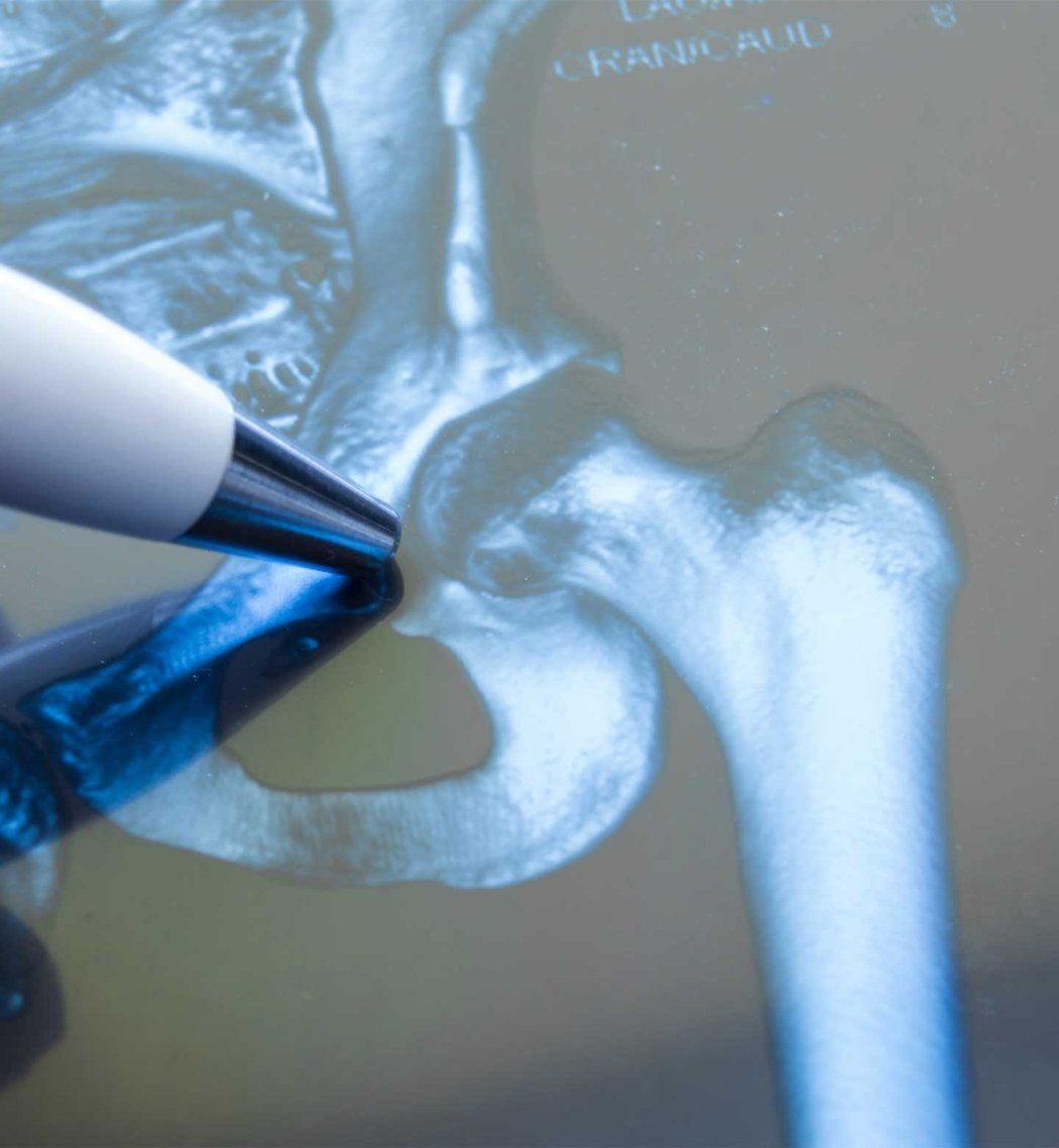 A pen points at a hip joint.