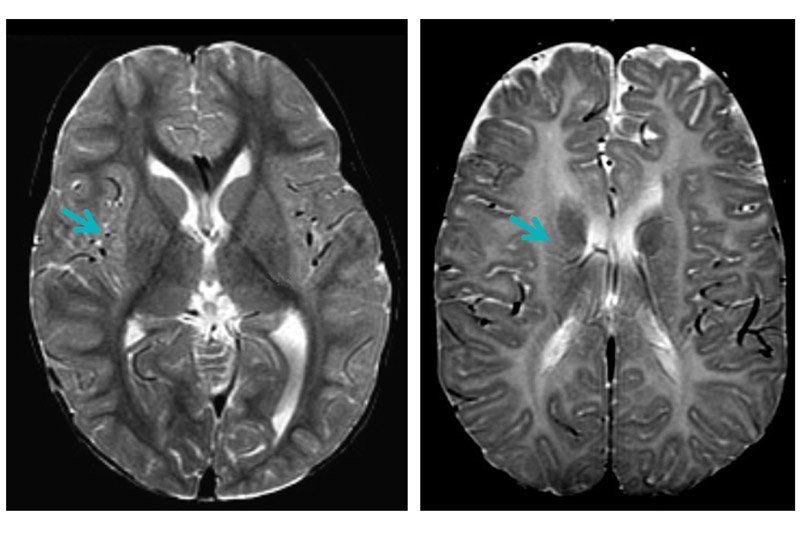 PMD brain scan