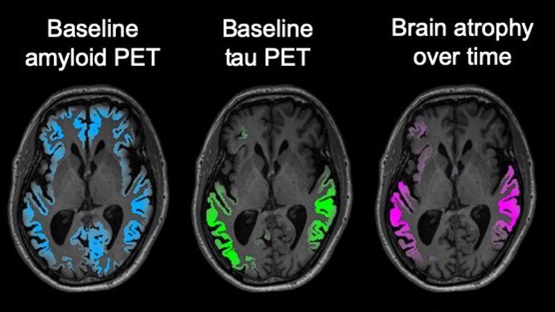 Brain MRI scans