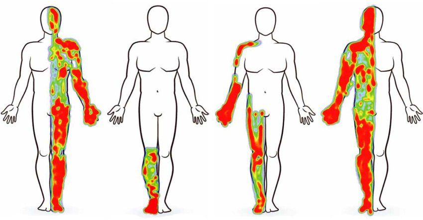 Four separate diagrams showing pain in study participants mapped over the human body