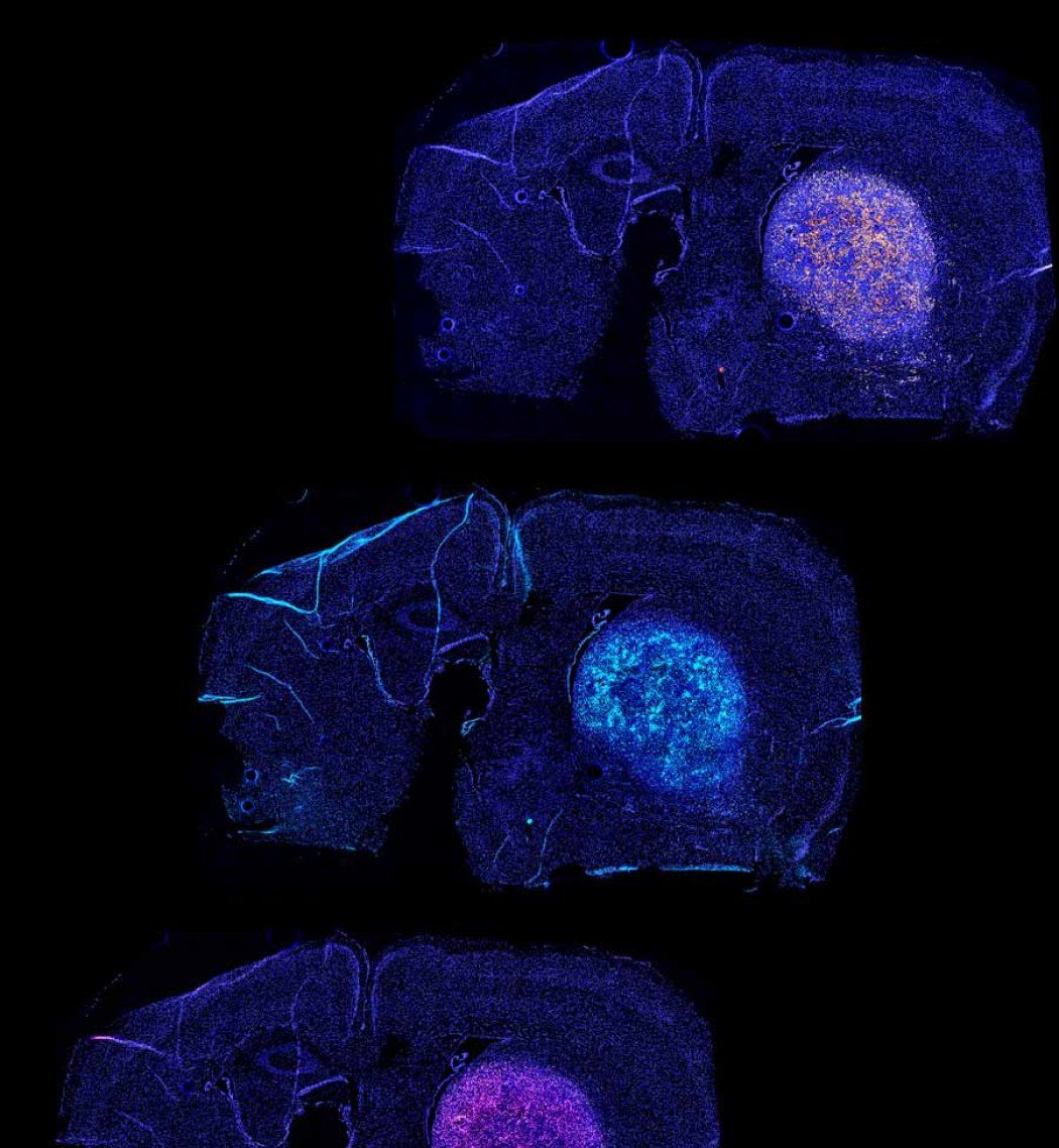 A series of three brain scans showing T-cells attacking a glioblastoma over time. The third scan shows dying glioblastoma cells.